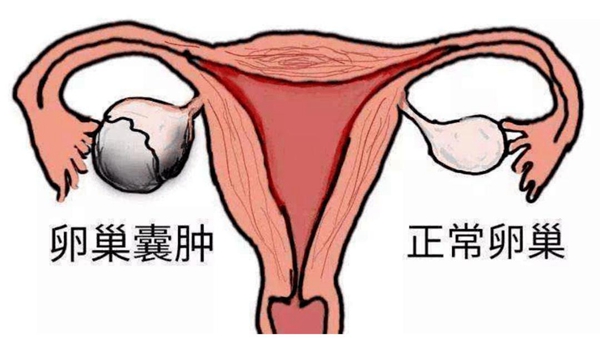 女性得了卵巢囊肿会影响怀孕生小孩吗