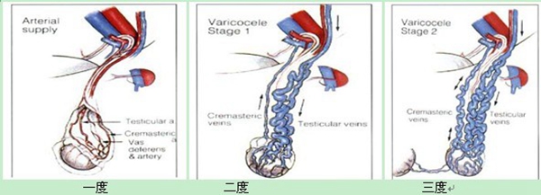 精索静脉曲张引起不孕不育