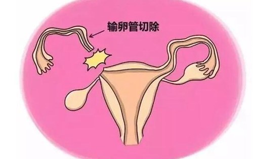 双侧输卵管切除后怎么怀孕 双侧输卵管切除后怎么怀孕