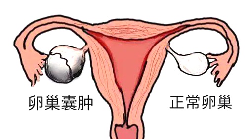 有卵巢囊肿做试管婴儿需要推迟吗 有卵巢囊肿做试管婴儿需要推迟吗