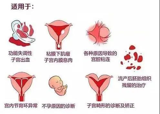 宫腹腔镜检查介绍