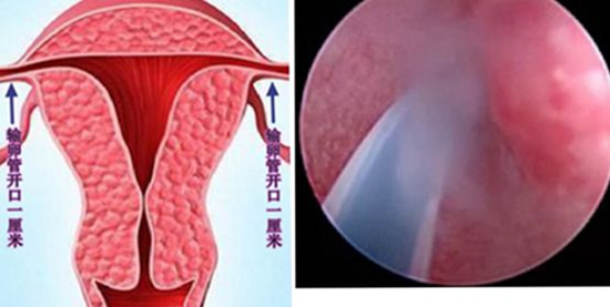 宫腹腔镜检查介绍