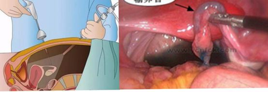 宫腹腔镜检查介绍